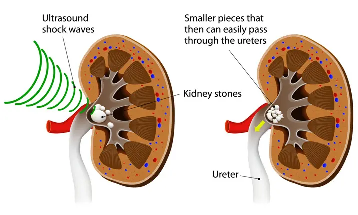 Kidney stones surgery - Lithotripsy