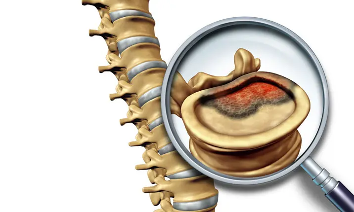 people with bone cancer