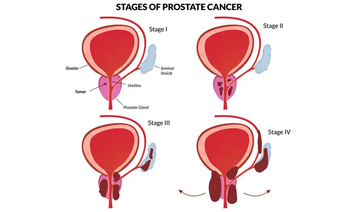 Stadium kanker prostat