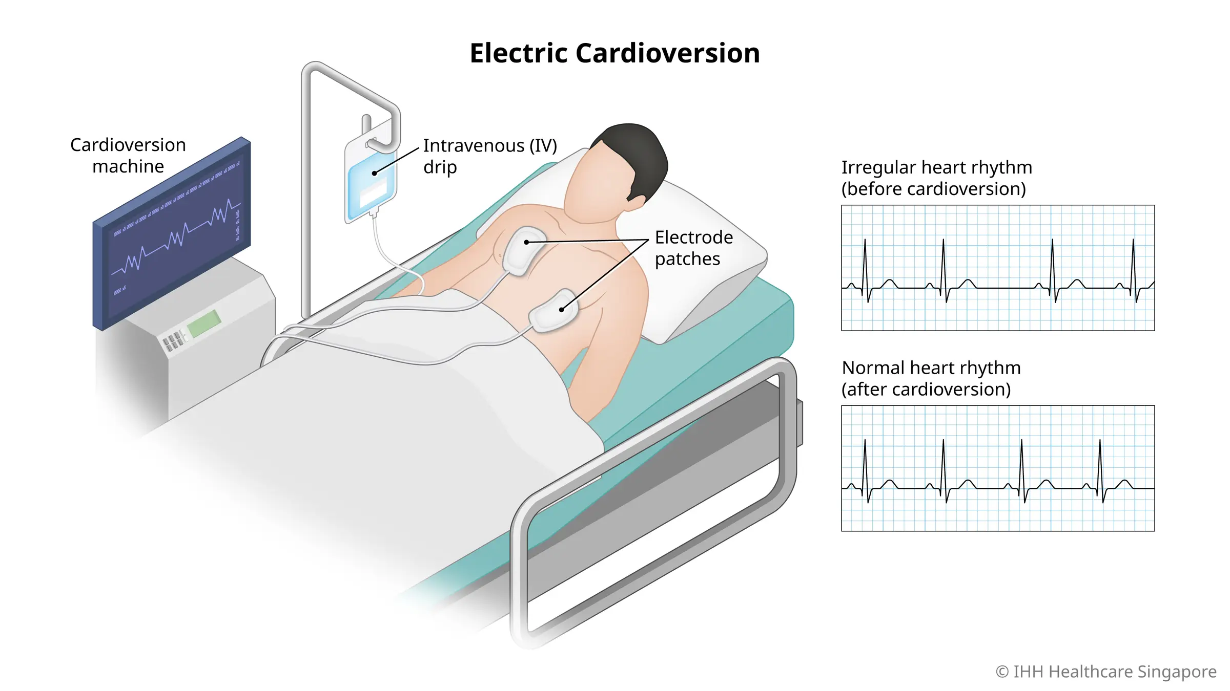 Electric cardioversion uses electrode patches to deliver an electrical shock to the heart to correct irregular heart rhythm. 
