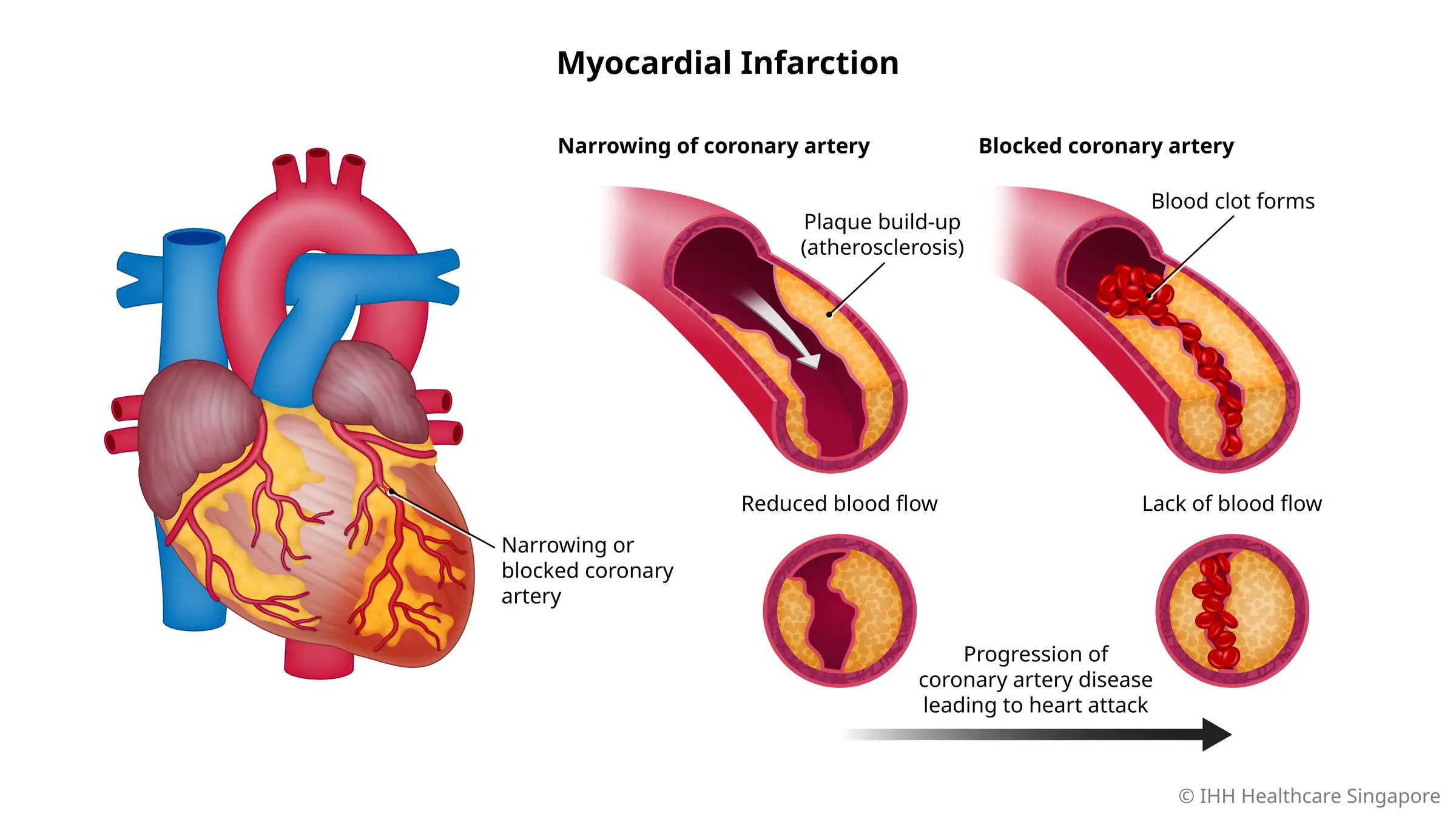 Nhồi máu cơ tim xảy ra khi lưu lượng máu đến tim bị giảm hoặc tắc nghẽn nghiêm trọng do xơ vữa động mạch.