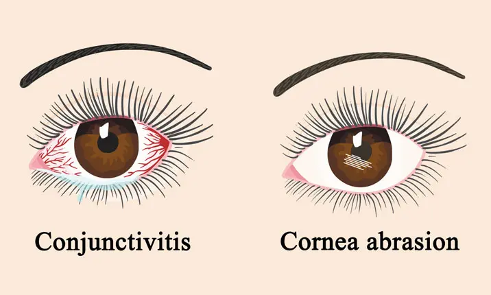 Complications of dry eyes