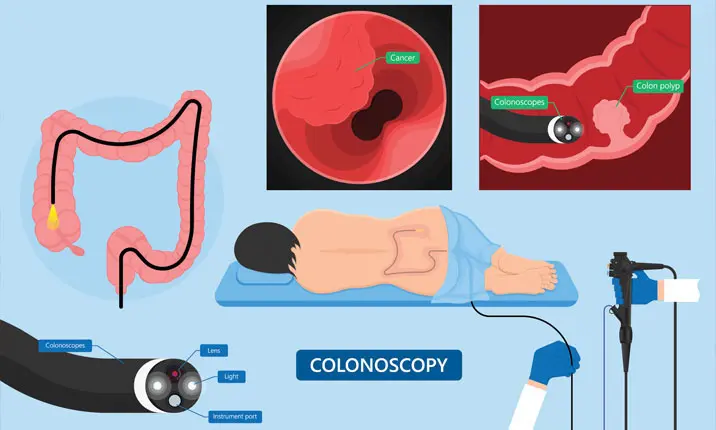 How is a colonoscopy performed?