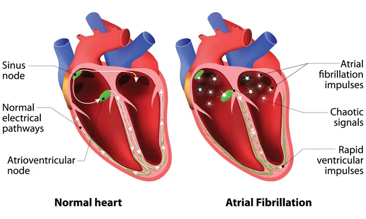 Abnormal heartbeat cardiac arrhythmia