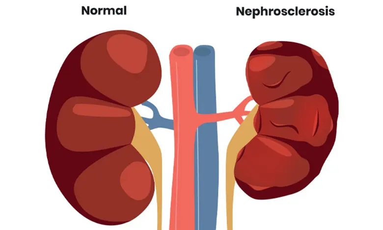 Kidney failure