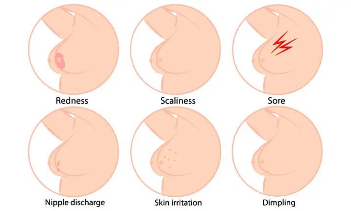 Breast lump warning signs