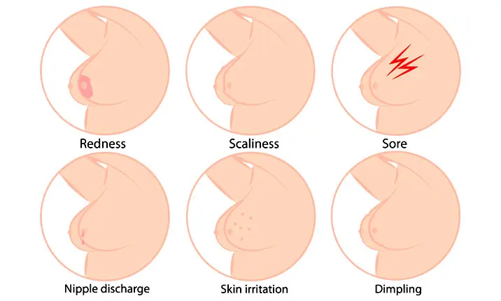 What do cancerous breast lumps feel like?