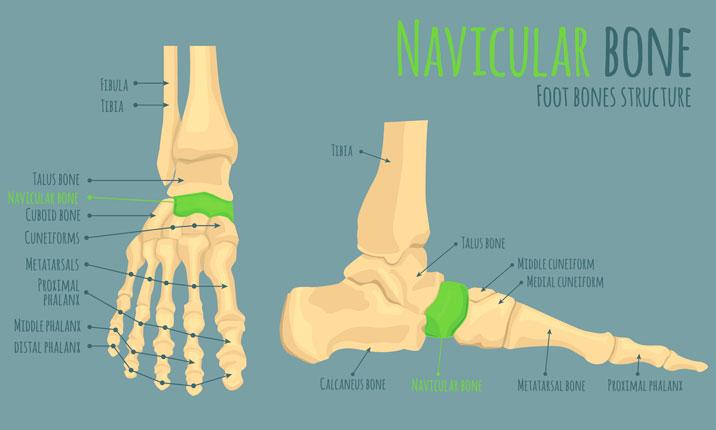 Stress Fracture of the Foot - Witty Pask amp Buckingham