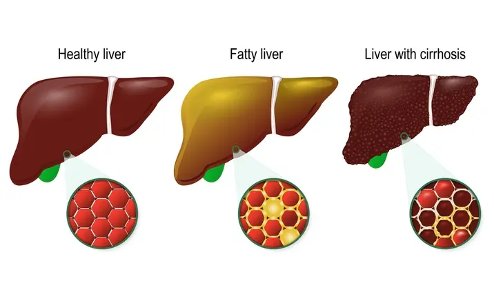 Myth fatty liver is not serious