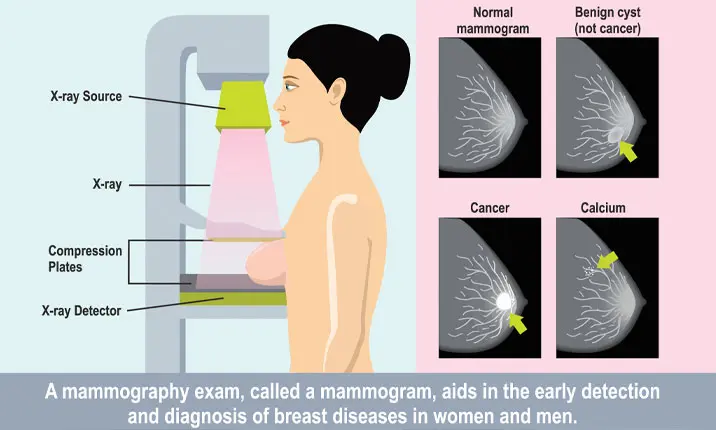 Do Mammograms Hurt?, Breast Cancer Screening