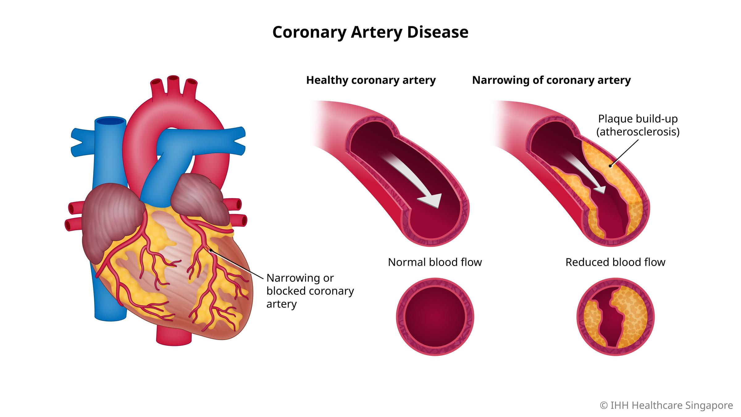 Coronary Artery Disease (CAD) - Causes And Symptoms | Parkway East Hospital