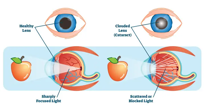 What is a cataract?