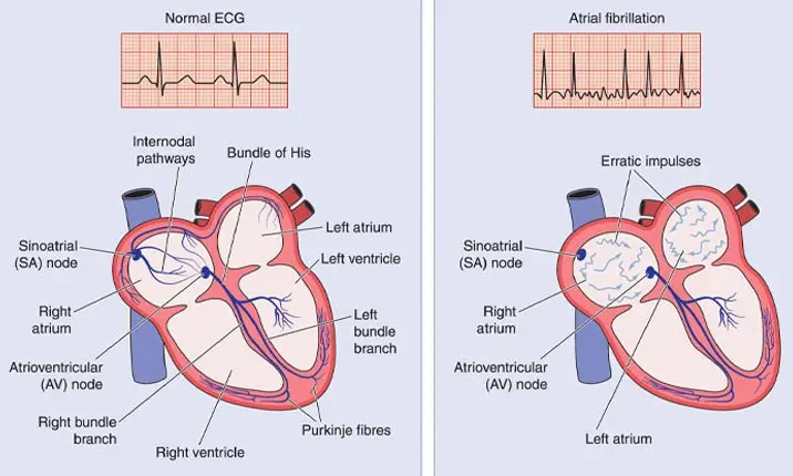 Fast heart rate (tachycardia)