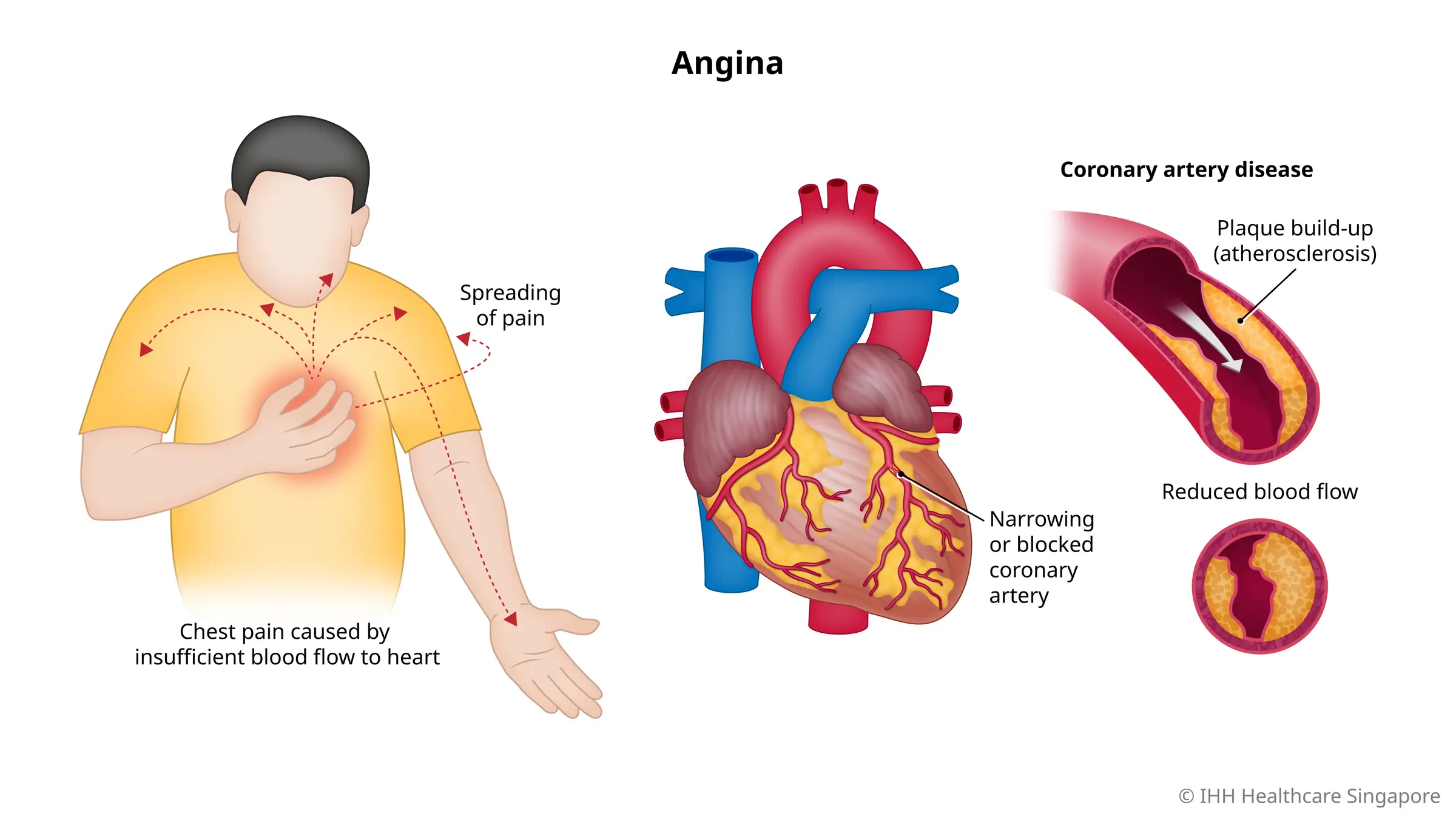 由于冠状动脉狭窄或阻塞而导致流向心脏的血流不足时便会发生心绞痛（胸痛）。