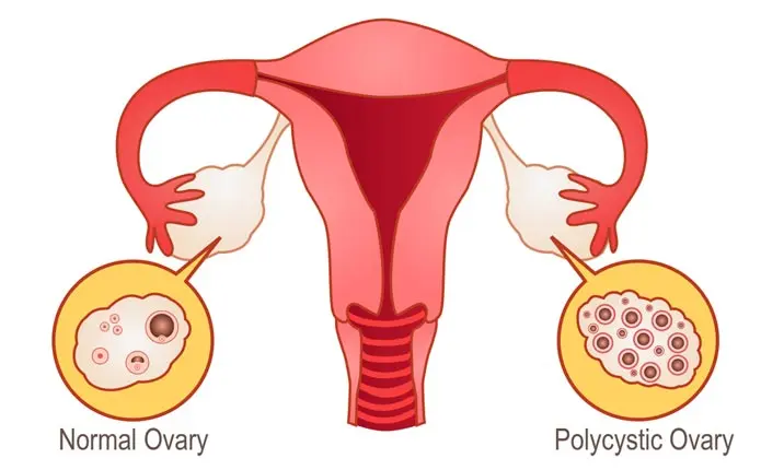 An ovarian cyst is a fluid-filled sac that forms on or within an ovary.  Ovarian cysts are quite common and often form during the menstrua