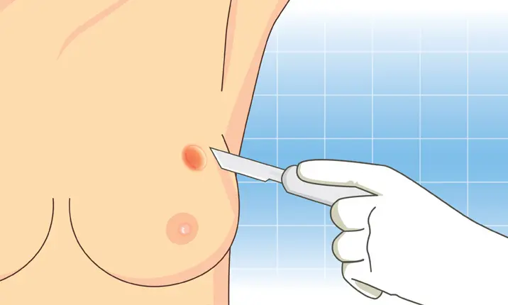 How to Prepare For a Breast Biopsy