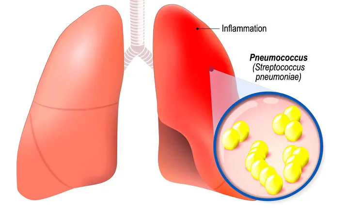 Causes of pneumonia