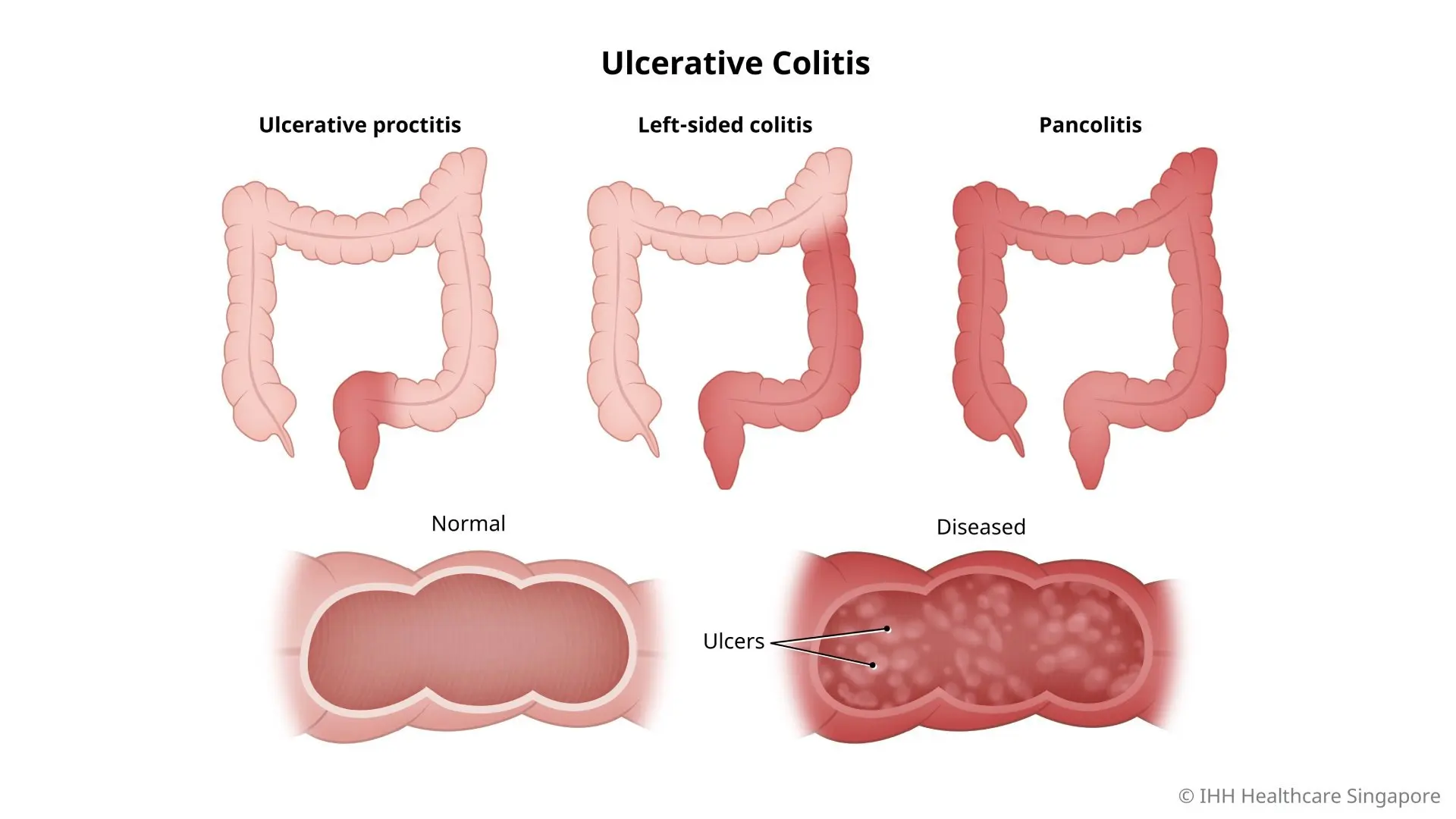 Illustration of the types of ulcerative colitis, which include ulcerative proctitis, left-sided colitis, and pancolitis.