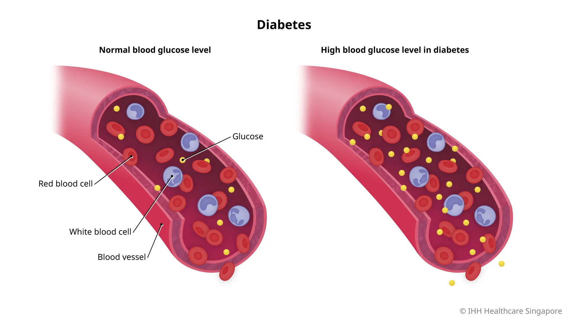 Diabetes - Gejala & Penyebab | Rumah Sakit Gleneagles