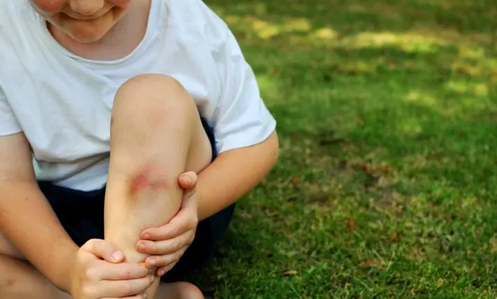 Child with bruised leg