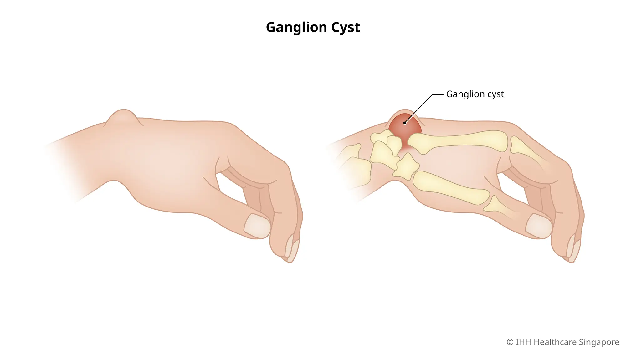 Nang hạch (Cổ tay, Ngón tay, Bàn chân, Mắt cá chân) - Nguyên nhân & Triệu  chứng | Bệnh viện Gleneagles