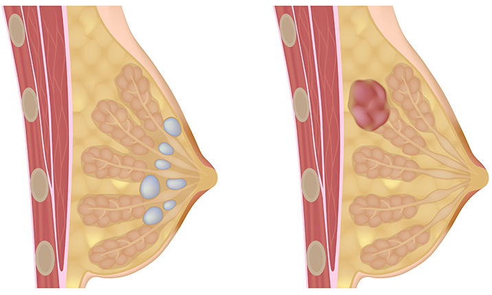 Breast cysts vs Fibroadenoma