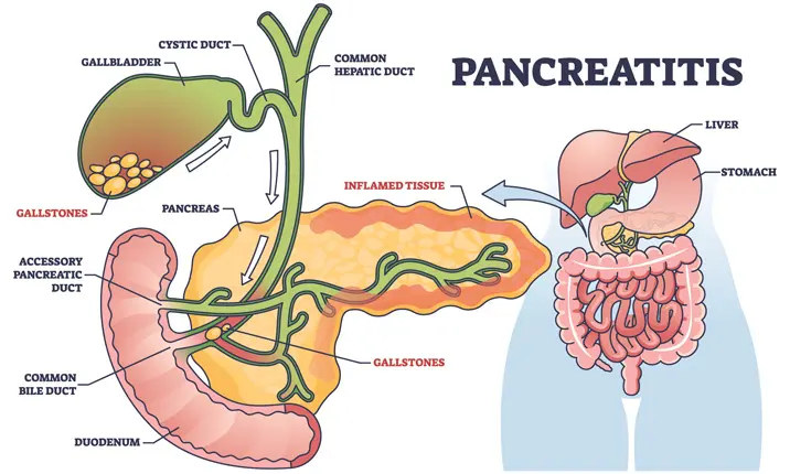 What is pancreatitis