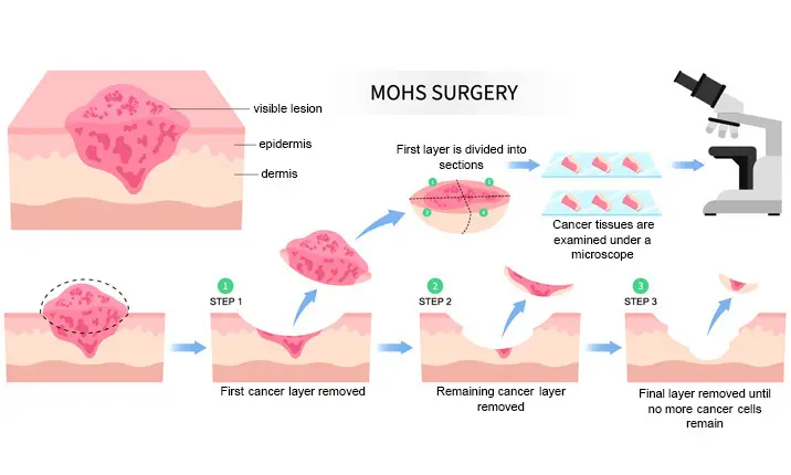 Apa yang dimaksud dengan bedah mikrografi Mohs?