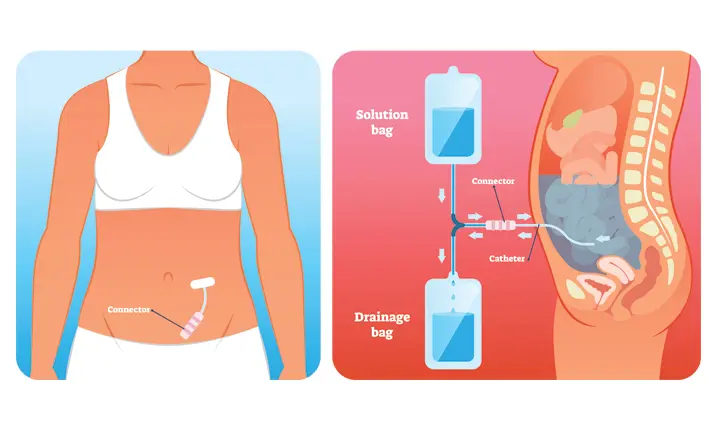 Apa itu dialisis peritoneal?