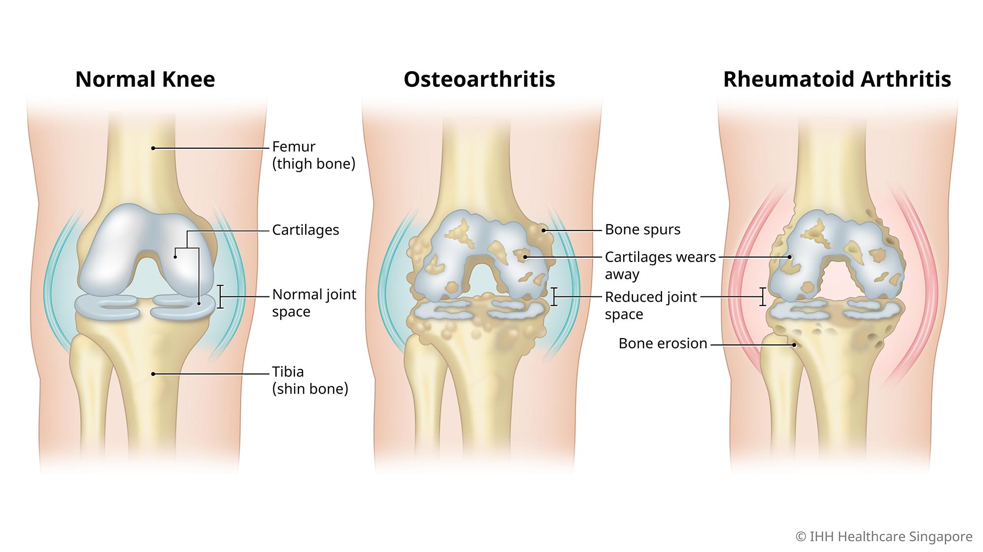 Comparing a healthy knee joint with arthritic knee joint.