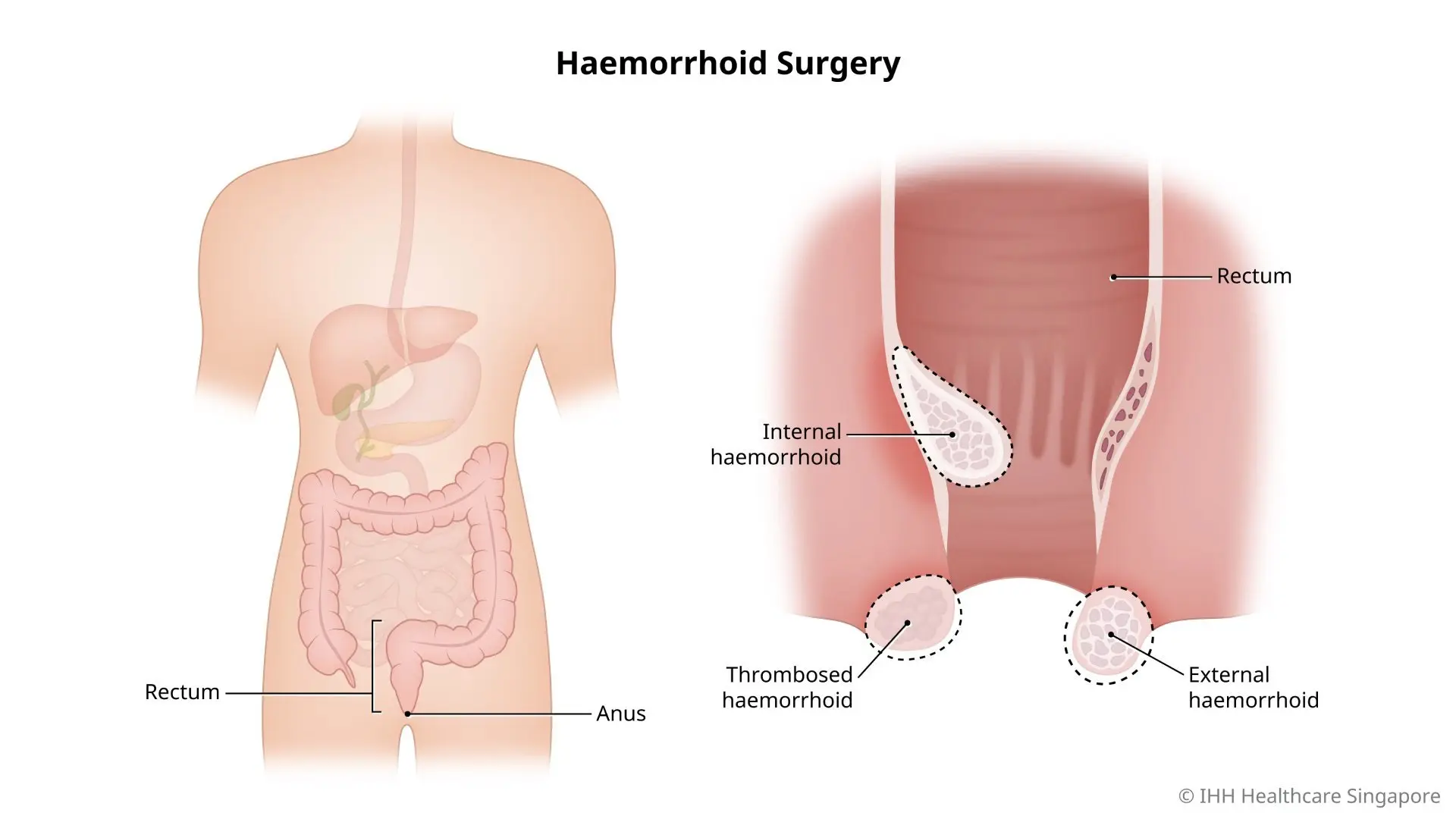 Illustration of haemorrhoid surgery, including internal, thrombosed, and external haemorrhoid surgery.