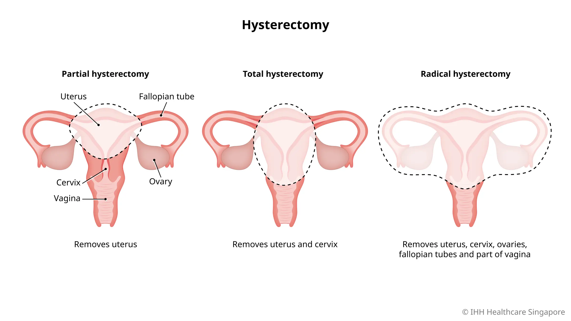 Hysterectomy Uterus Removal Gleneagles Hospital