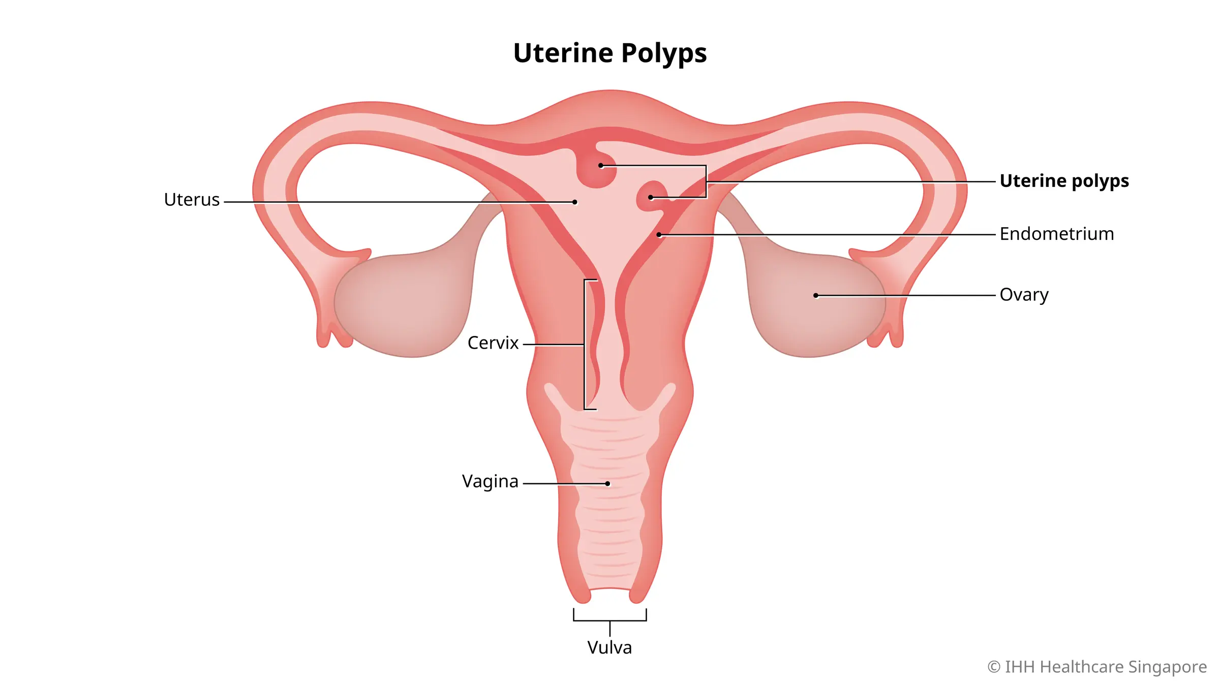 What are uterine (endometrial) polyps?