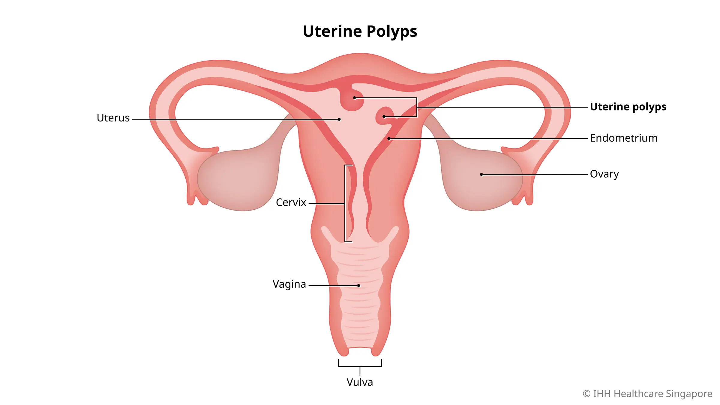 Polyp tử cung (nội mạc tử cung) là gì?