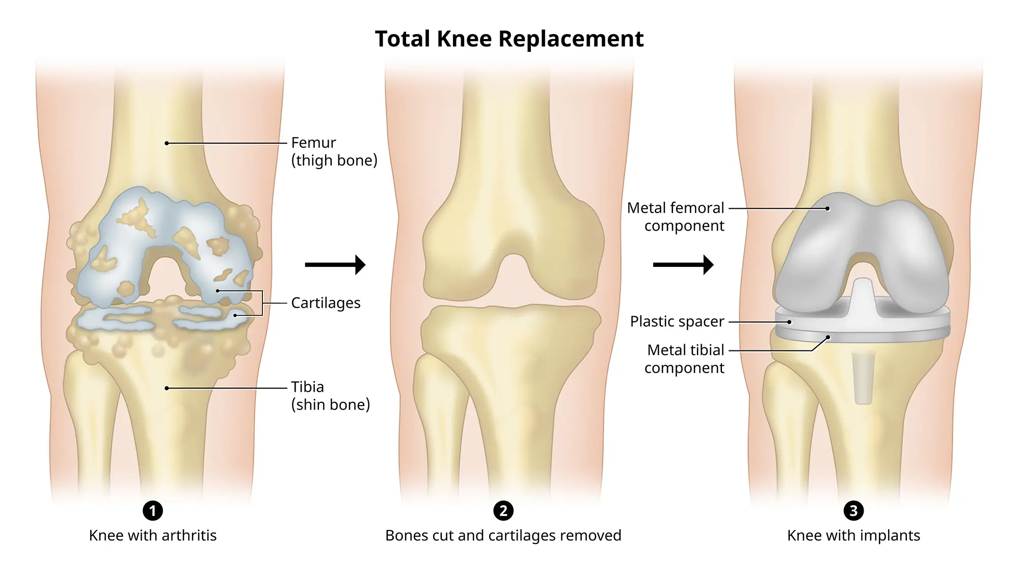 In a total knee replacement procedure, the damaged end of the femur and end of the tibia are removed and replaced with prosthesis