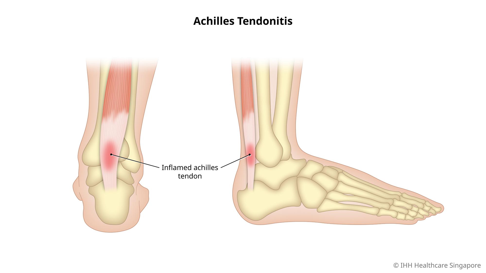 Achilles tendonitis is an inflammation of the achilles tendon due to overuse or injury.