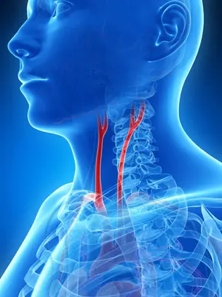 carotid arteries x-ray