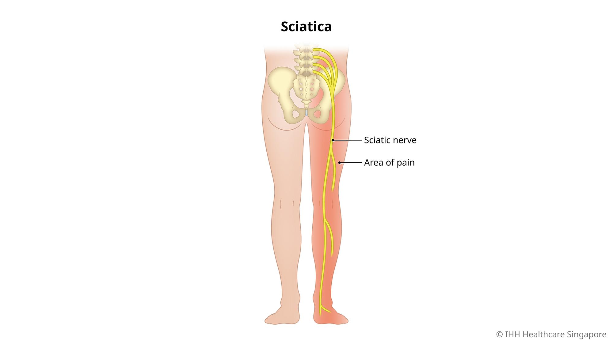 pinched nerve in leg