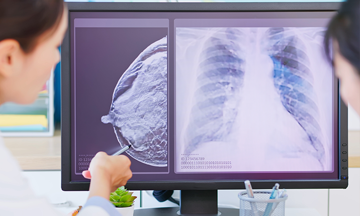 Close asian woman has breast cancer