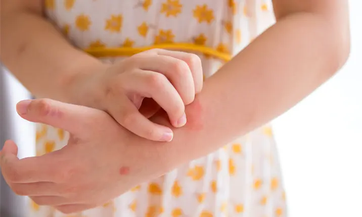 Children's gut health and eczema