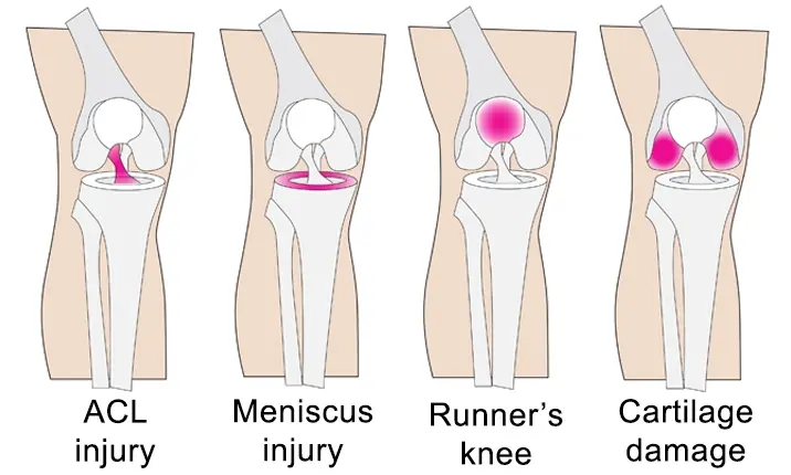Cedera yang diobati dengan artroskopi pemeliharaan lutut