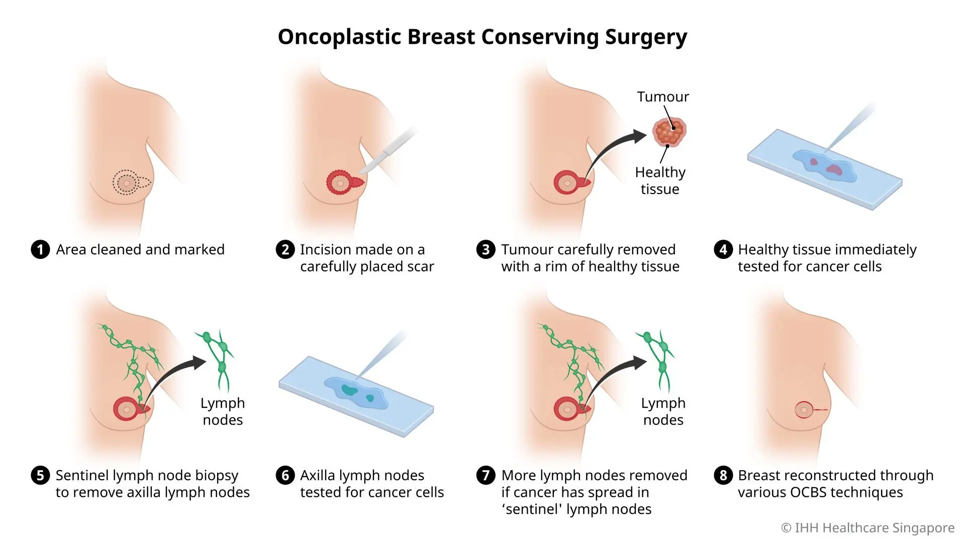 Illustration of the steps in an oncoplastic breast-conserving surgery.