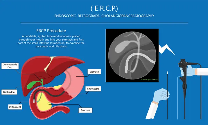 Endoscopic Retrograde Cholangiopancreatography