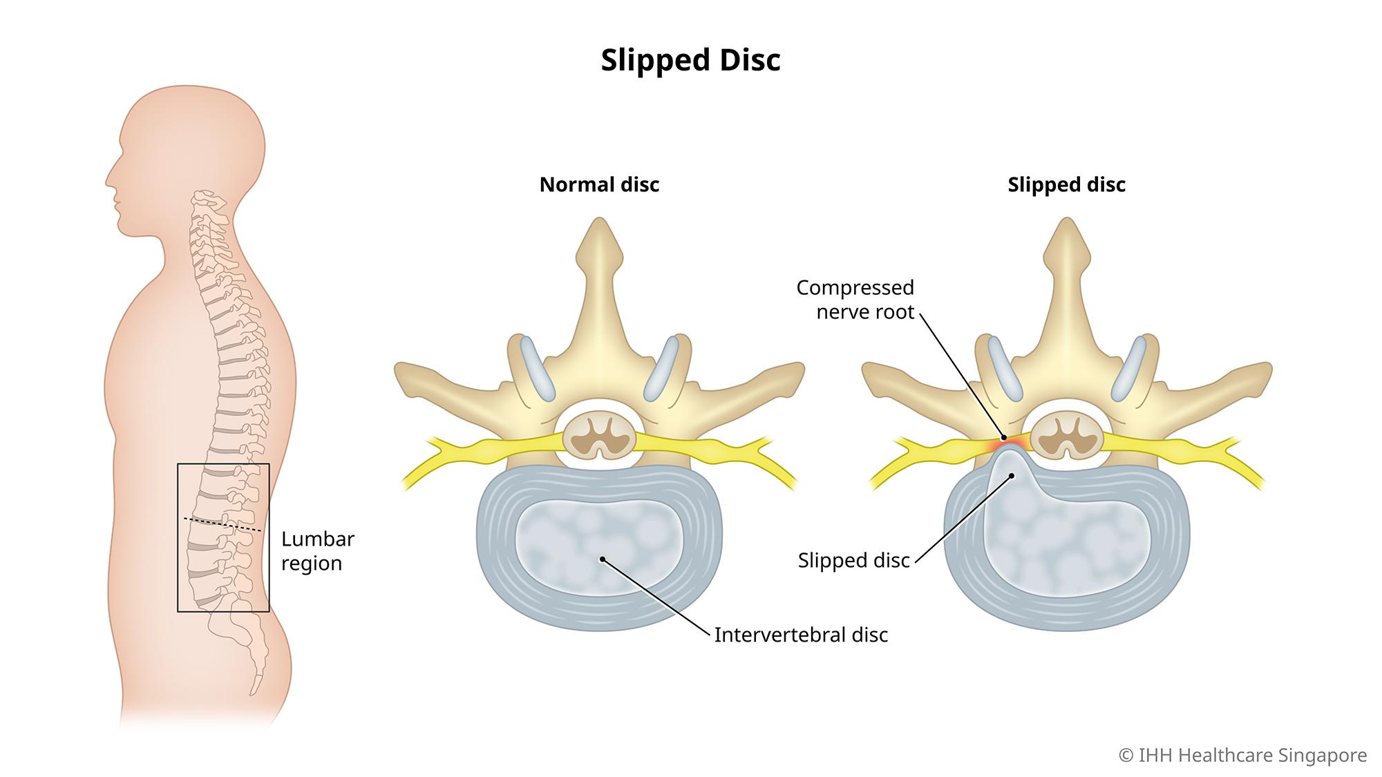 The internal gel filling in the spine is pushed out, causing it to press on the nerve root