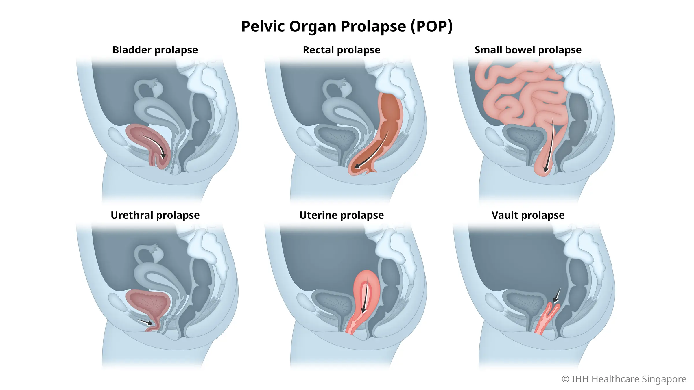 Prolaps organ panggul atau POP terjadi ketika organ di area panggul turun dari posisi normalnya