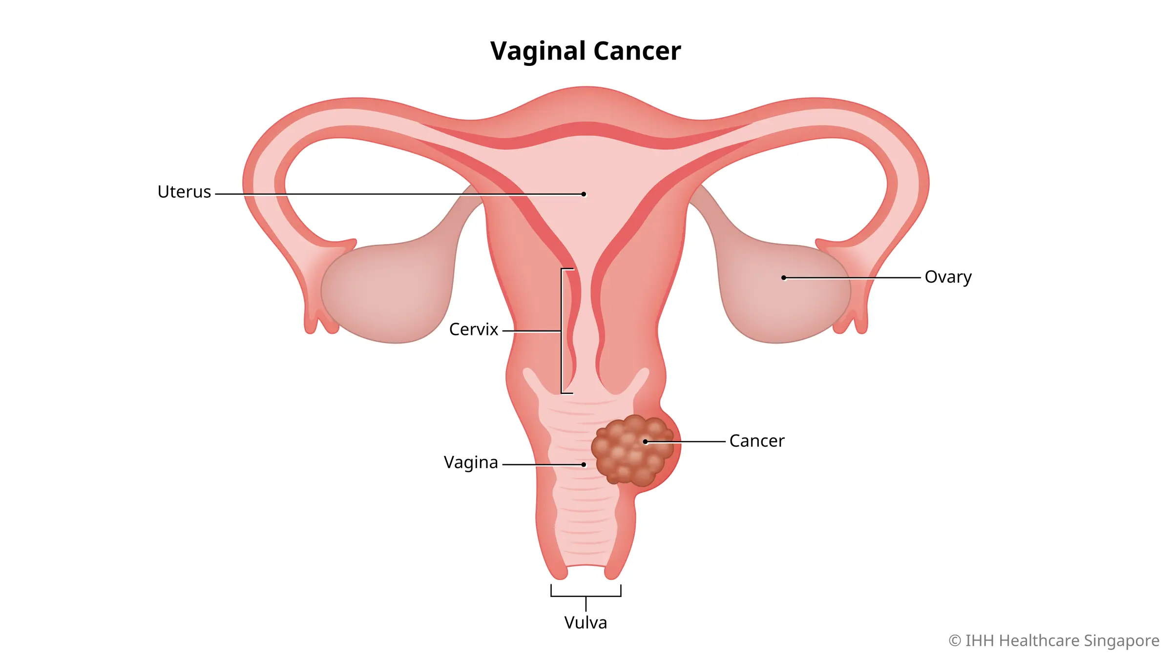 What is vaginal cancer?