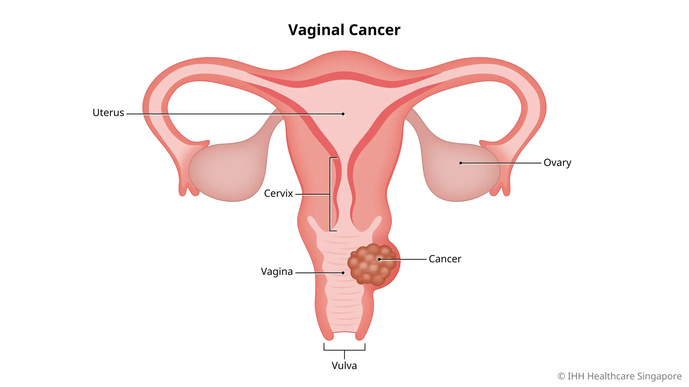 United Medicity, Multispecialty Hospital, Malignant cells originate in  the vagina and cause vaginal cancer. Unexpected vaginal bleeding, watery  vaginal discharge, a lump, painful