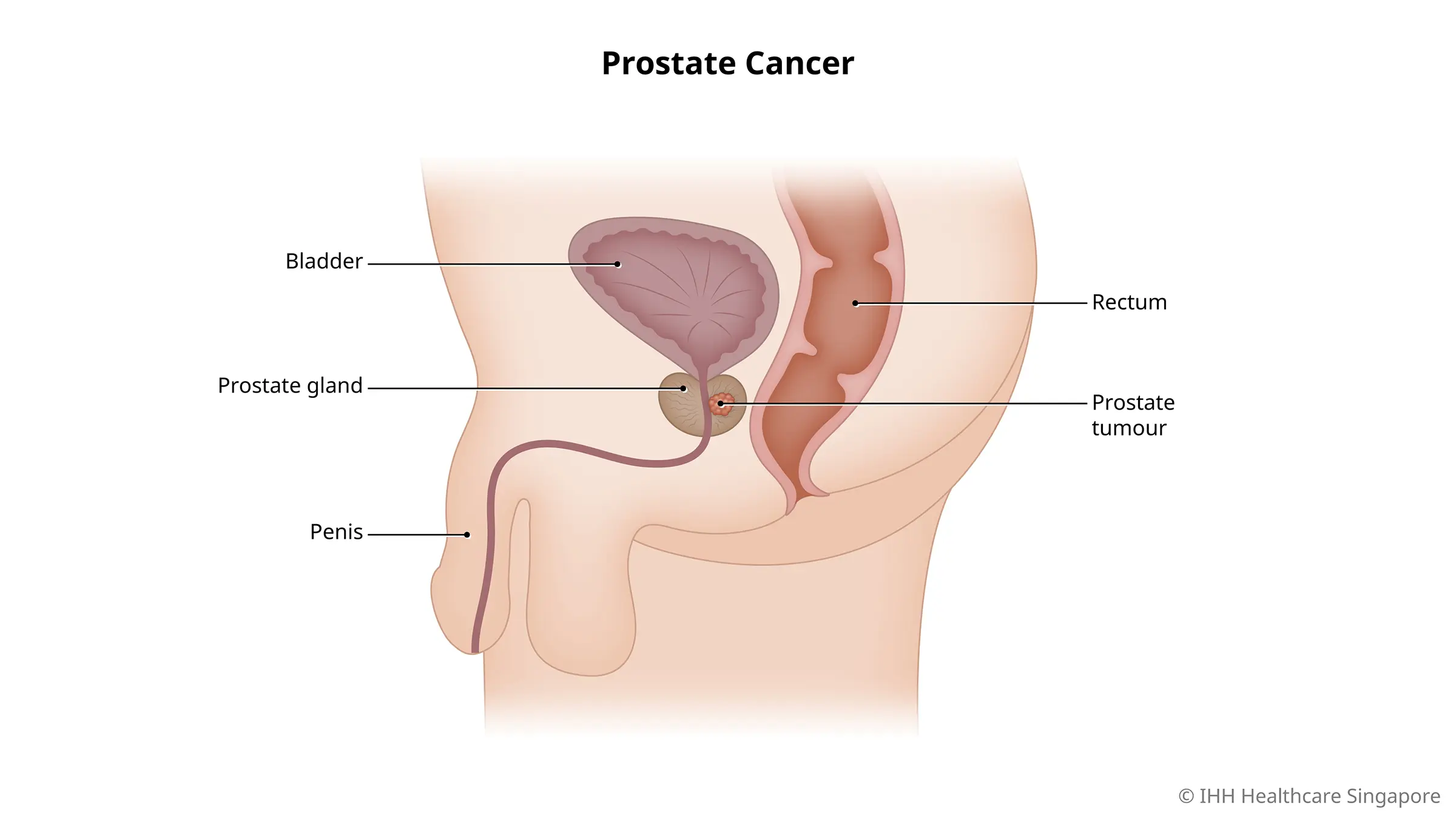 Prostate Cancer Symptoms Causes Parkway East Hospital