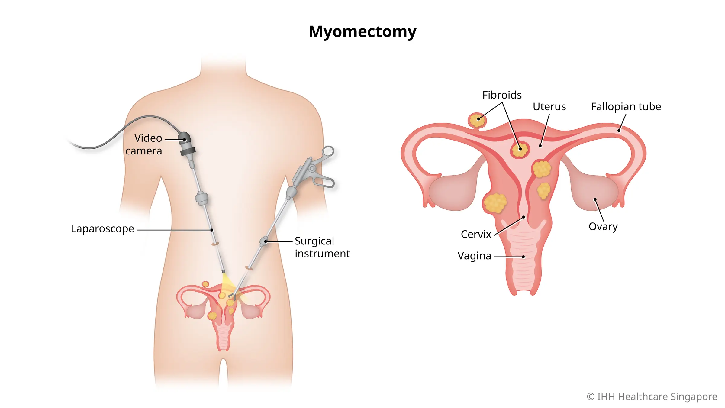 laparoscopic myomectomy procedure