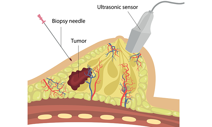 Breast biopsy techniques